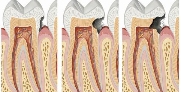 龋齿1.png 龋齿1.png