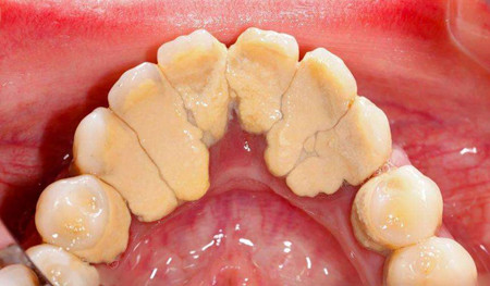 牙结石.jpg