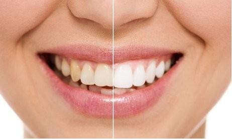 牙齿不美观，如何进行修复？