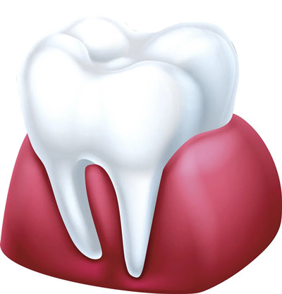 做正畸前，为什么要先治疗牙周病？